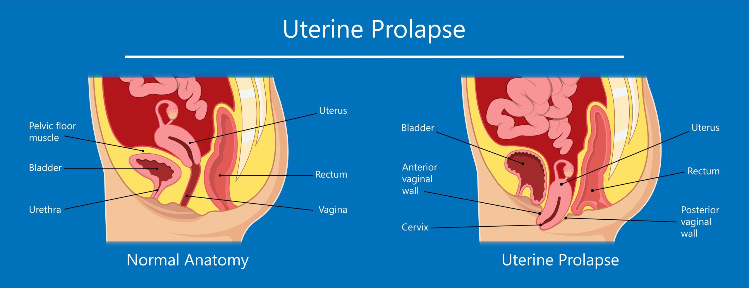Pelvic organ prolapse (POP) is a condition that occurs when one or more pelvic organs, such as the uterus, bladder, or rectum, descend or shift from their normal positions