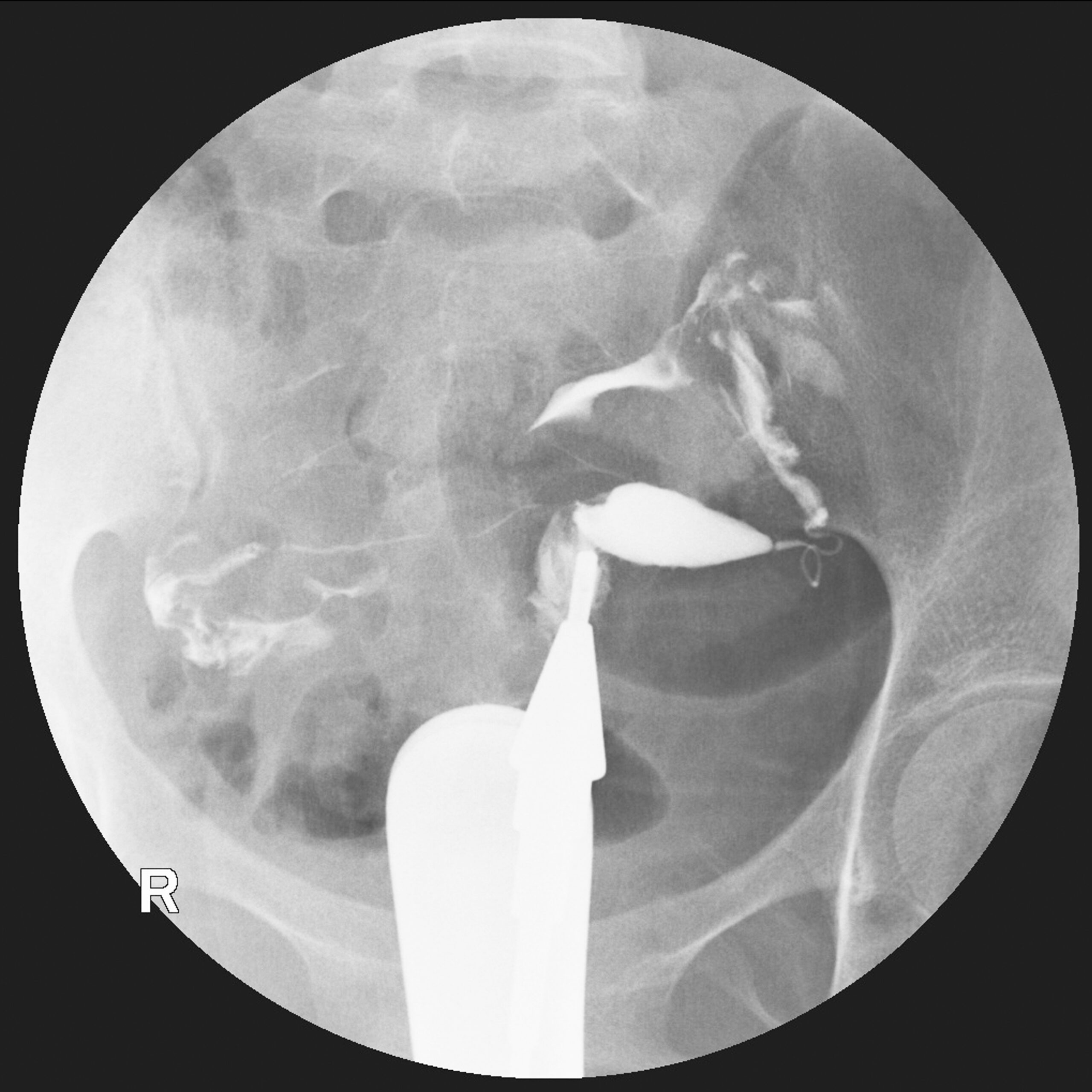 Hysterosalpingography (HSG) is a fluoroscopic X-ray study of a woman's uterus and fallopian tubes