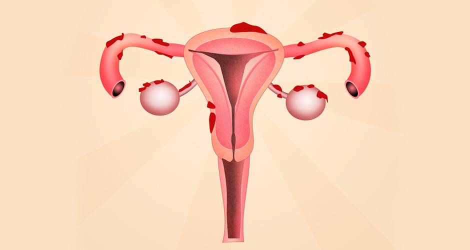 Stages Of Endometriosis